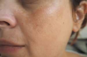 melasma